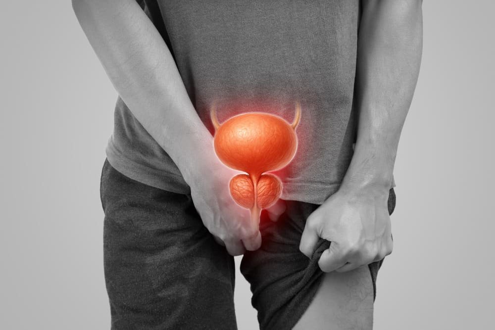 Cirugía radical de próstata (prostatectomía radical)