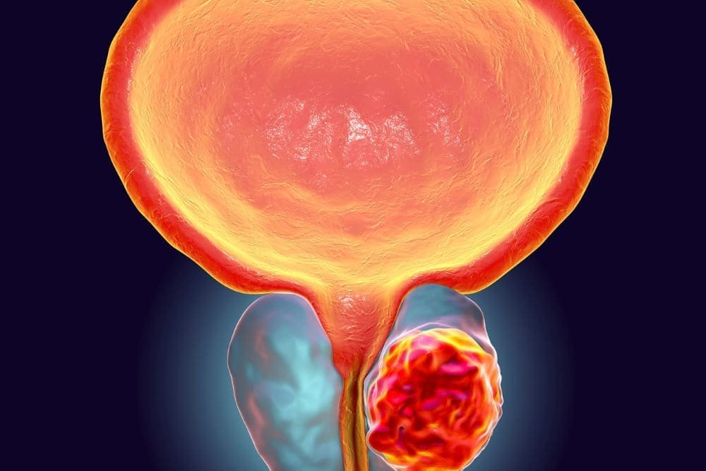 Enucleación prostática con láser Holmium (HoLEP) en Puebla: Técnica avanzada y mínimamente invasiva